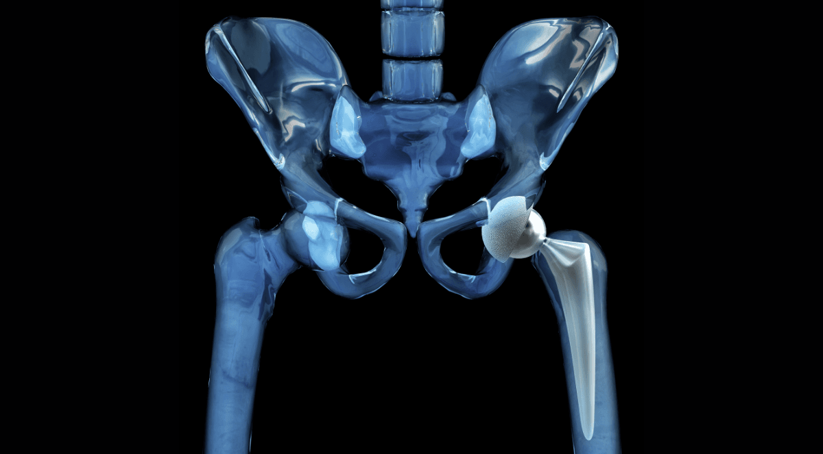 What I Wish I Knew Before Hip Replacement Surgery