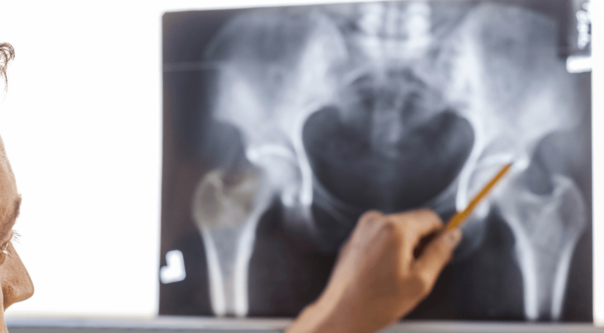 Why Hip Replacement in Mexico Might Be Right for You: Exploring Benefits and Options
