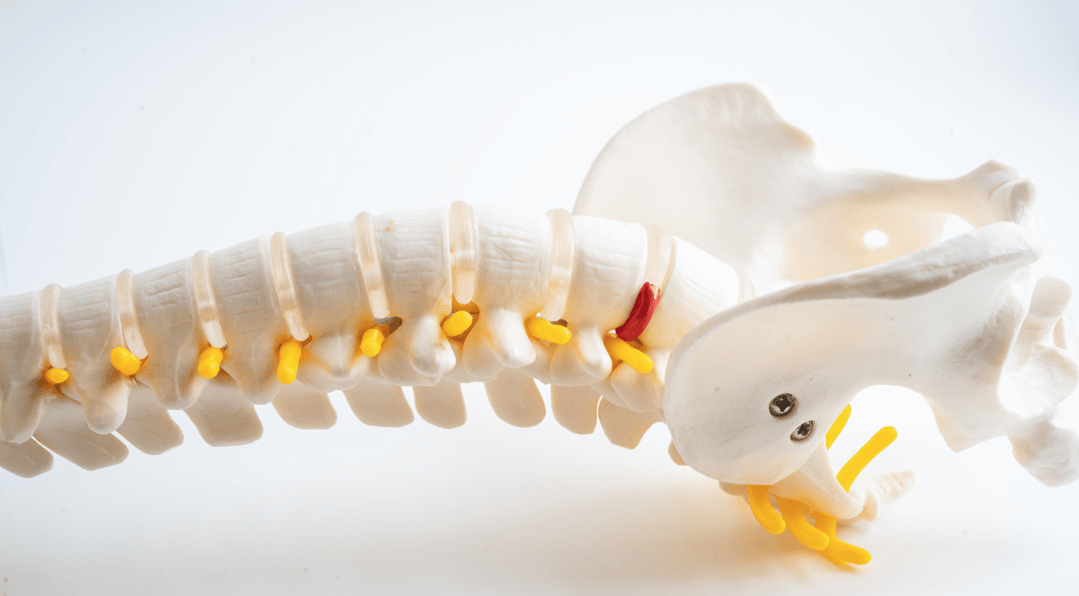 Can Back Surgery Help with Sciatica Pain? Exploring Treatment Options