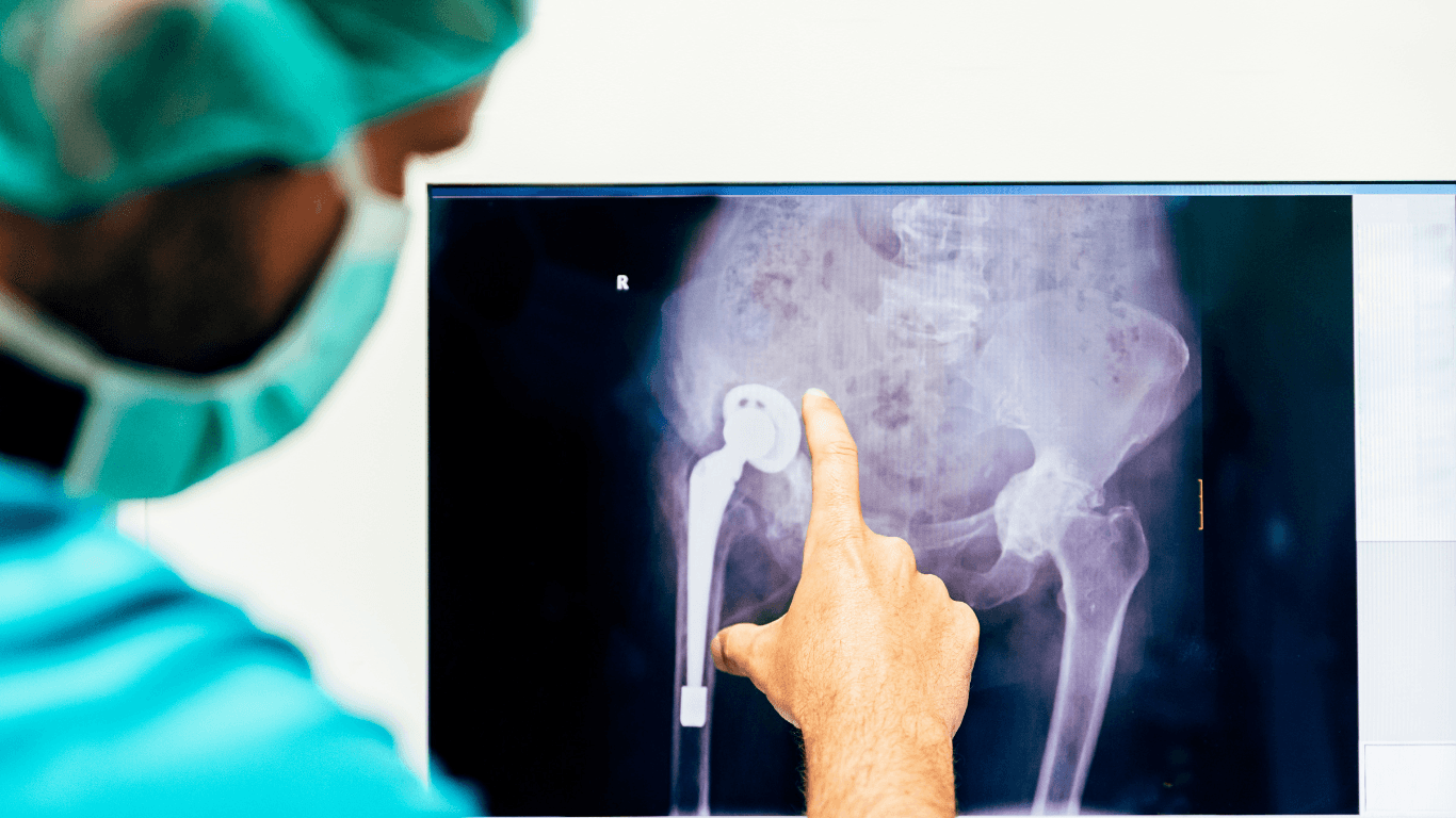 Hip Replacement vs Partial Hip Replacement Outcomes: Durability, Risks, and Patient Satisfaction