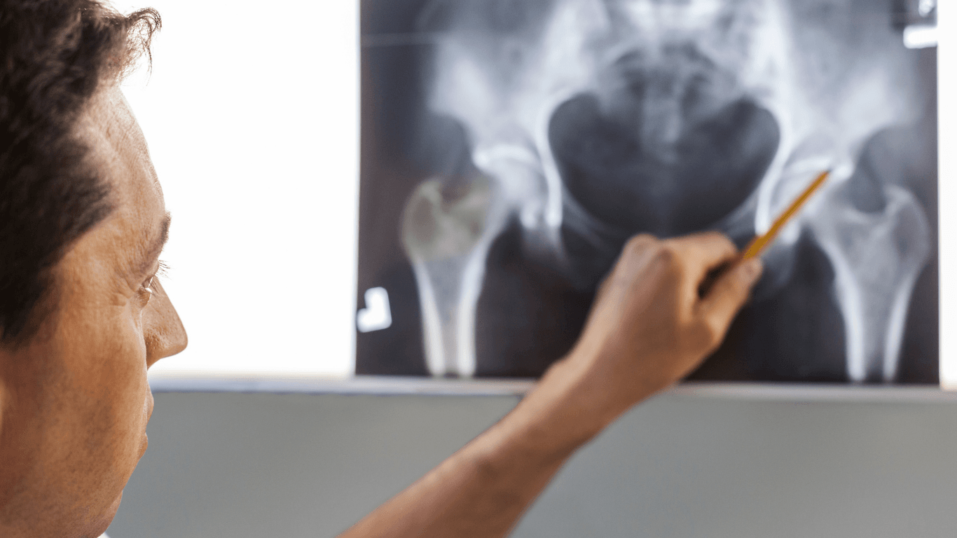 Hip Replacement Surgery: When Is It the Right Choice?